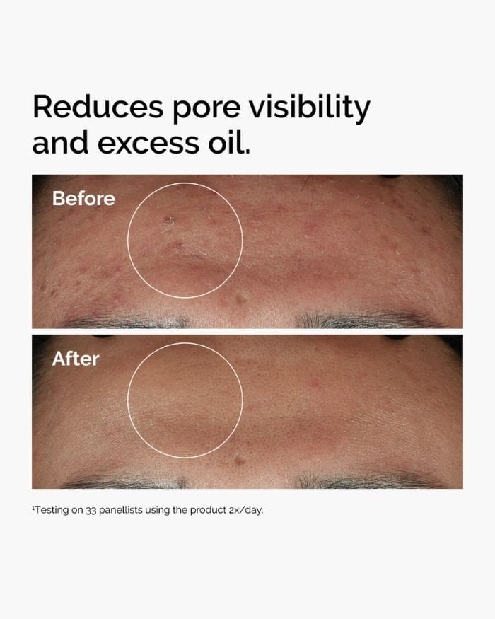 Niacinamide 10% Zinc 1% Results Niacinamide 10% Zinc 1% Results