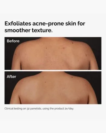 Salicylic Acid 0.5% Body Serum Back Results